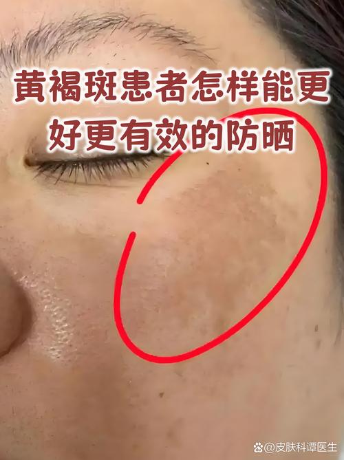 电脑辐射斑,你在这里见过吗?