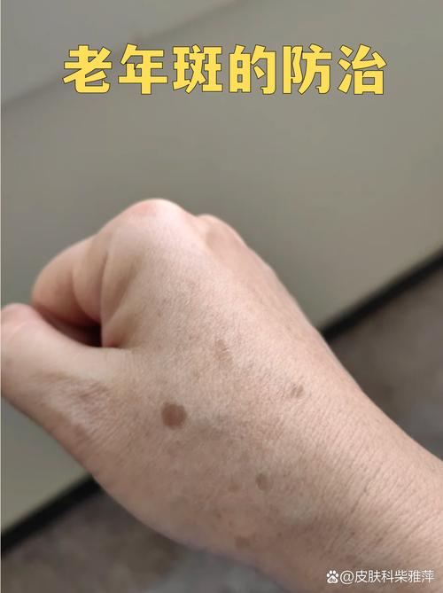 电脑辐射斑,一个值得警惕的问题